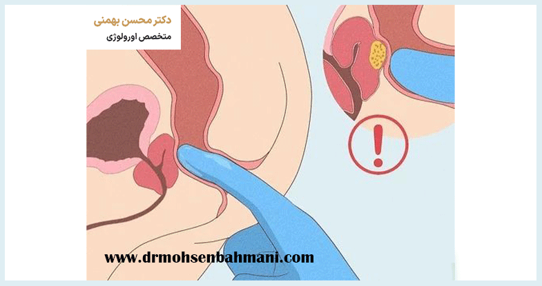 بیماری پروستات