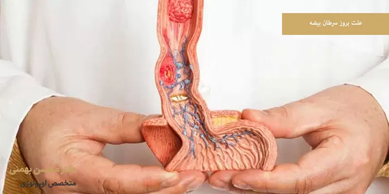علت بروز سرطان بیضه