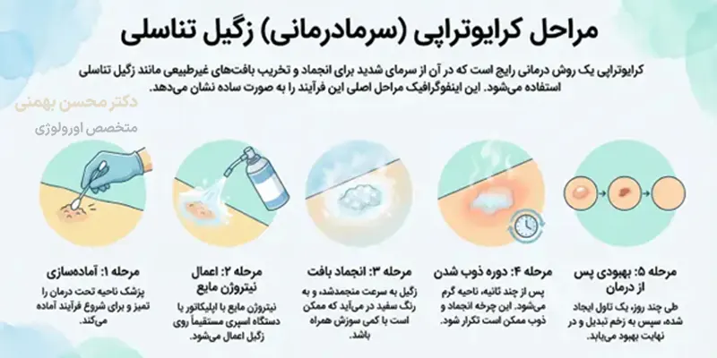 مراحل درمان کرایوتراپی زگیل تناسلی